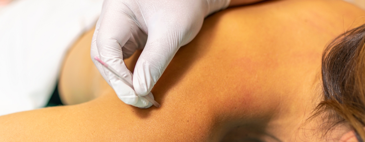 Dry-needling-header-Cornerstone-Physical-Therapy-Fort-Worth-TX.jpg